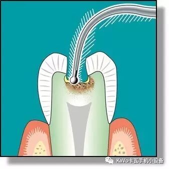 气动洁牙机怎么样卡瓦 SONICflex 气动洁牙机--多功能工作尖_https://www.jmylbn.com_新闻资讯_第74张