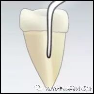 气动洁牙机怎么样卡瓦 SONICflex 气动洁牙机--多功能工作尖_https://www.jmylbn.com_新闻资讯_第46张