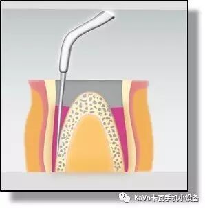 气动洁牙机怎么样卡瓦 SONICflex 气动洁牙机--多功能工作尖_https://www.jmylbn.com_新闻资讯_第133张