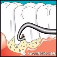 气动洁牙机怎么样卡瓦 SONICflex 气动洁牙机--多功能工作尖_https://www.jmylbn.com_新闻资讯_第42张