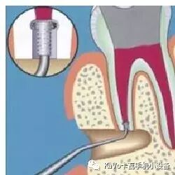 气动洁牙机怎么样卡瓦 SONICflex 气动洁牙机--多功能工作尖_https://www.jmylbn.com_新闻资讯_第114张