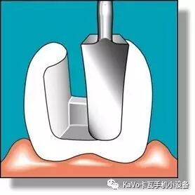 气动洁牙机怎么样卡瓦 SONICflex 气动洁牙机--多功能工作尖_https://www.jmylbn.com_新闻资讯_第91张