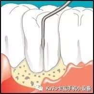 气动洁牙机怎么样卡瓦 SONICflex 气动洁牙机--多功能工作尖_https://www.jmylbn.com_新闻资讯_第44张