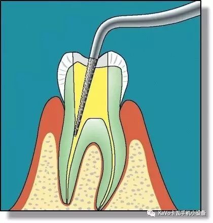 气动洁牙机怎么样卡瓦 SONICflex 气动洁牙机--多功能工作尖_https://www.jmylbn.com_新闻资讯_第124张