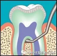 气动洁牙机怎么样卡瓦 SONICflex 气动洁牙机--多功能工作尖_https://www.jmylbn.com_新闻资讯_第40张