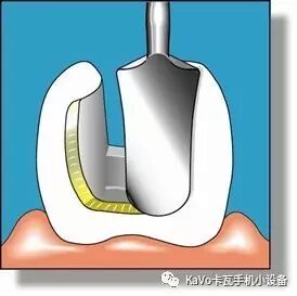 气动洁牙机怎么样卡瓦 SONICflex 气动洁牙机--多功能工作尖_https://www.jmylbn.com_新闻资讯_第85张