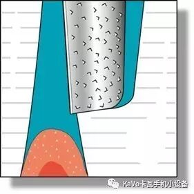 气动洁牙机怎么样卡瓦 SONICflex 气动洁牙机--多功能工作尖_https://www.jmylbn.com_新闻资讯_第92张