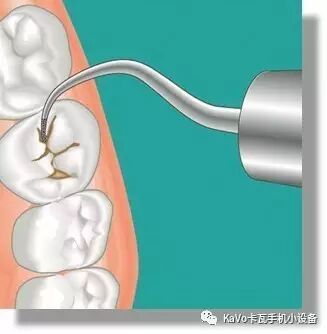 气动洁牙机怎么样卡瓦 SONICflex 气动洁牙机--多功能工作尖_https://www.jmylbn.com_新闻资讯_第68张