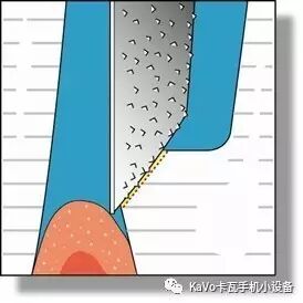 气动洁牙机怎么样卡瓦 SONICflex 气动洁牙机--多功能工作尖_https://www.jmylbn.com_新闻资讯_第86张