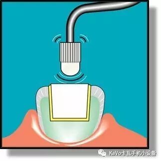 气动洁牙机怎么样卡瓦 SONICflex 气动洁牙机--多功能工作尖_https://www.jmylbn.com_新闻资讯_第103张