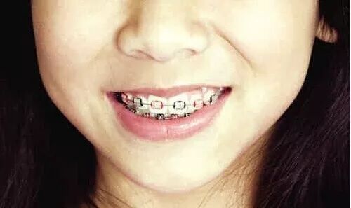 疫情期间，带牙套的你把牙齿刷干净太重要了！