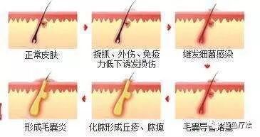 【蓝疗科普】毛囊炎、疖、痈、皮脂腺囊肿怎么区分？