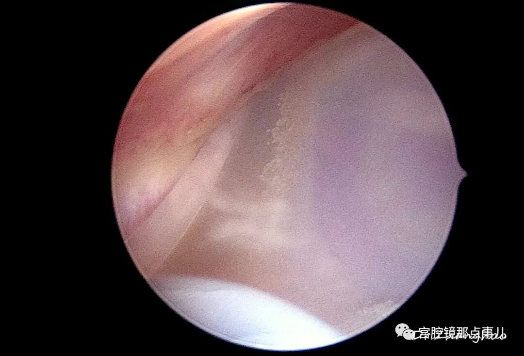 宫腔球囊怎么取出【腔镜科普】老张为什么反对宫内长效球囊？_https://www.jmylbn.com_新闻资讯_第9张