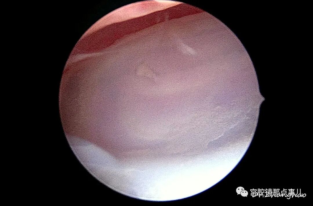 宫腔球囊怎么取出【腔镜科普】老张为什么反对宫内长效球囊？_https://www.jmylbn.com_新闻资讯_第8张