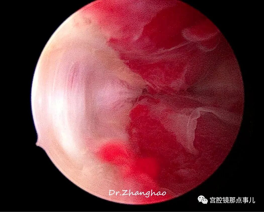 宫腔球囊怎么取出【腔镜科普】老张为什么反对宫内长效球囊？_https://www.jmylbn.com_新闻资讯_第12张