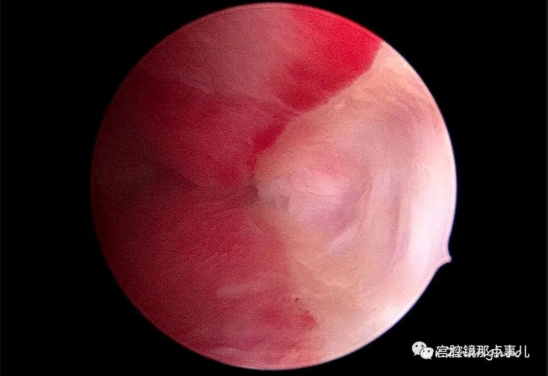 宫腔球囊怎么取出【腔镜科普】老张为什么反对宫内长效球囊？_https://www.jmylbn.com_新闻资讯_第11张