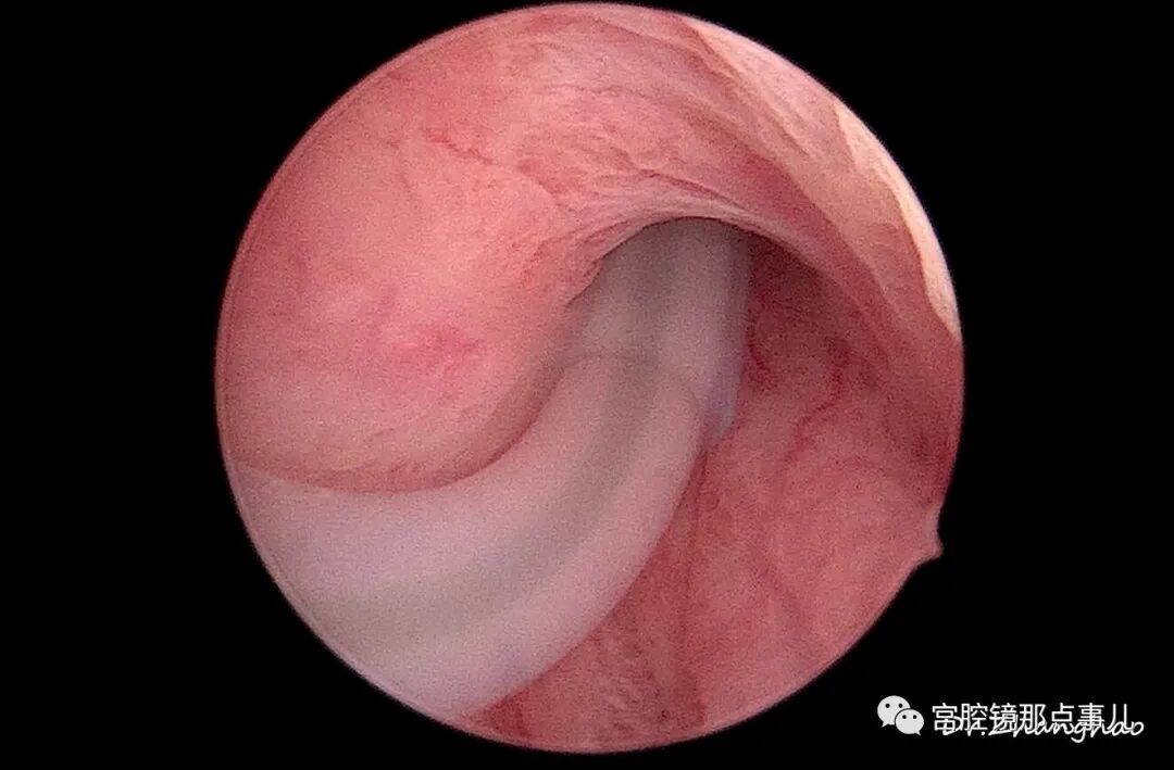 宫腔球囊怎么取出【腔镜科普】老张为什么反对宫内长效球囊？_https://www.jmylbn.com_新闻资讯_第6张