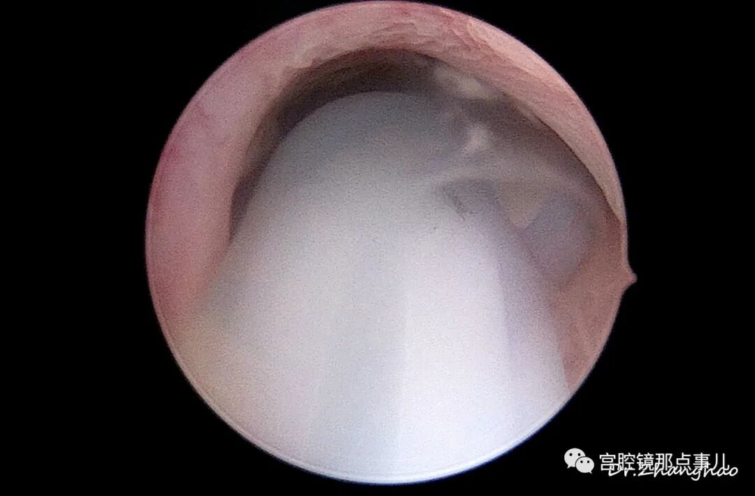 宫腔球囊怎么取出【腔镜科普】老张为什么反对宫内长效球囊？_https://www.jmylbn.com_新闻资讯_第7张