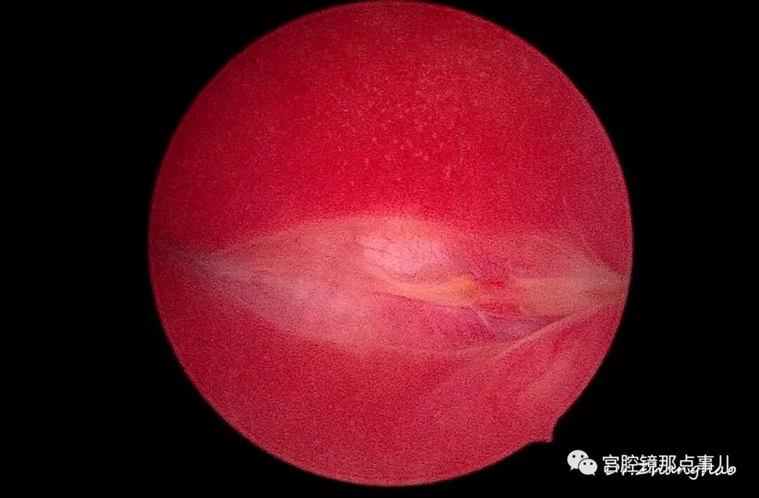 宫腔球囊怎么取出【腔镜科普】老张为什么反对宫内长效球囊？_https://www.jmylbn.com_新闻资讯_第13张