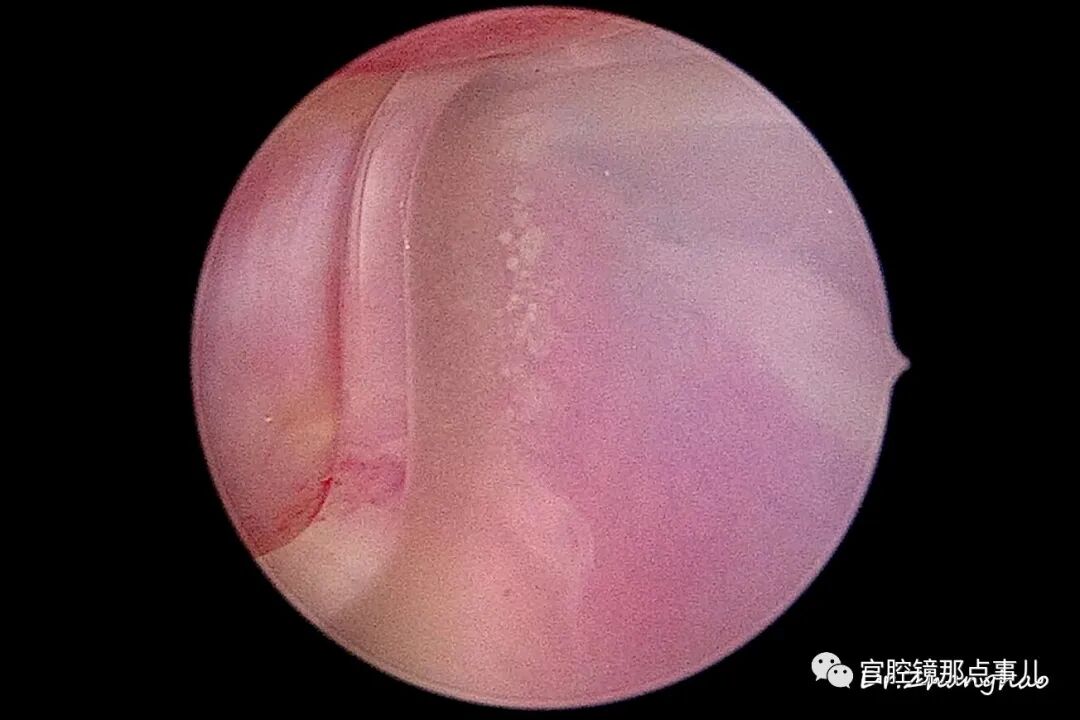 宫腔球囊怎么取出【腔镜科普】老张为什么反对宫内长效球囊？_https://www.jmylbn.com_新闻资讯_第10张