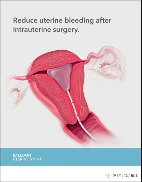 宫腔球囊怎么取出【腔镜科普】老张为什么反对宫内长效球囊？_https://www.jmylbn.com_新闻资讯_第4张