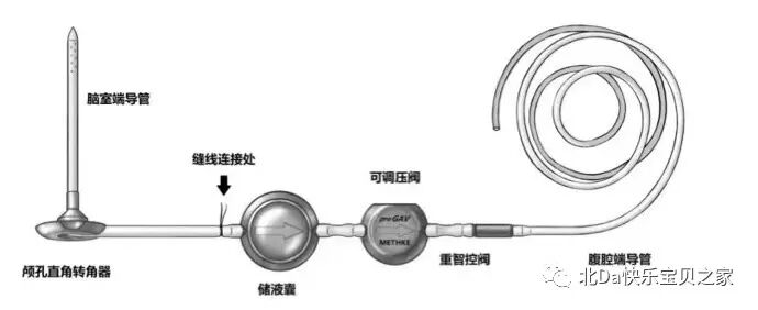 美敦力品牌怎么样各品牌脑室腹腔分流管类型收集及图例_https://www.jmylbn.com_新闻资讯_第12张