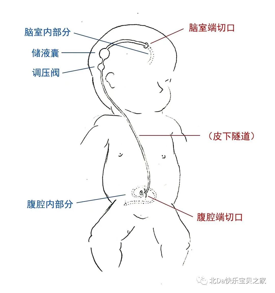 美敦力品牌怎么样各品牌脑室腹腔分流管类型收集及图例_https://www.jmylbn.com_新闻资讯_第1张