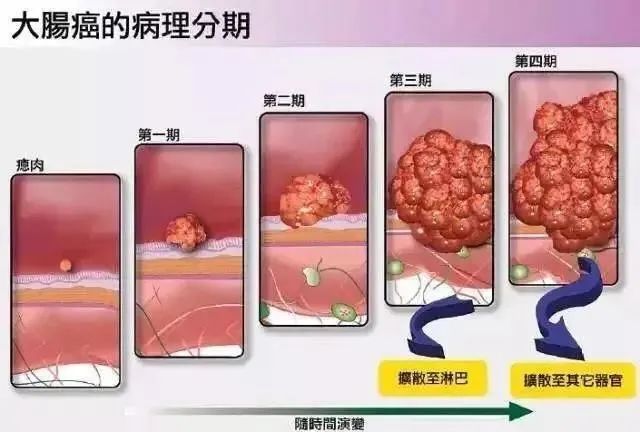 痔疮,息肉,肠癌