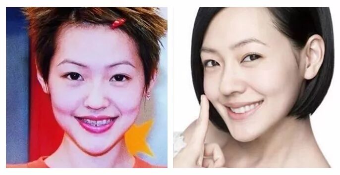 《小s牙套日记》