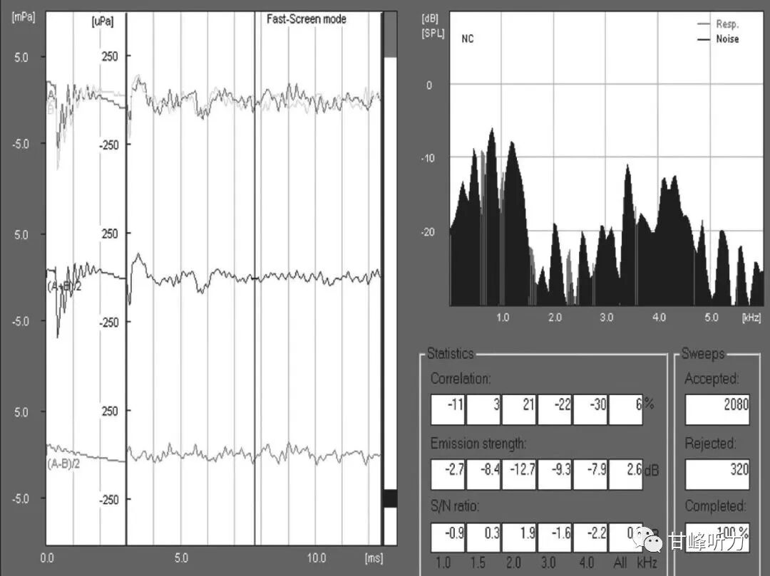 耳声发射图怎么看一分钟听力知识课堂丨耳声发射_https://www.jmylbn.com_新闻资讯_第5张