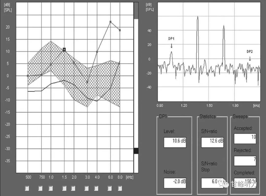 耳声发射图怎么看一分钟听力知识课堂丨耳声发射_https://www.jmylbn.com_新闻资讯_第6张