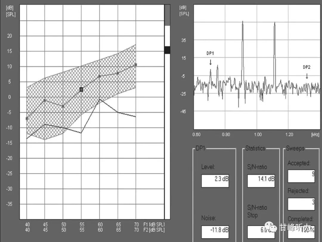 耳声发射图怎么看一分钟听力知识课堂丨耳声发射_https://www.jmylbn.com_新闻资讯_第7张