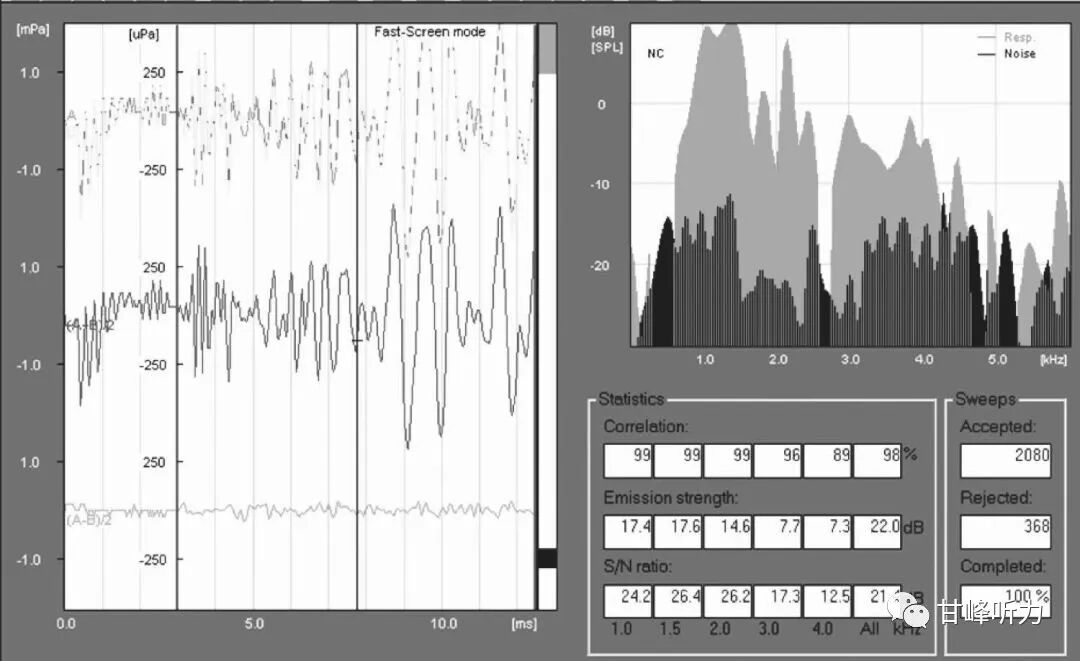 耳声发射图怎么看一分钟听力知识课堂丨耳声发射_https://www.jmylbn.com_新闻资讯_第4张