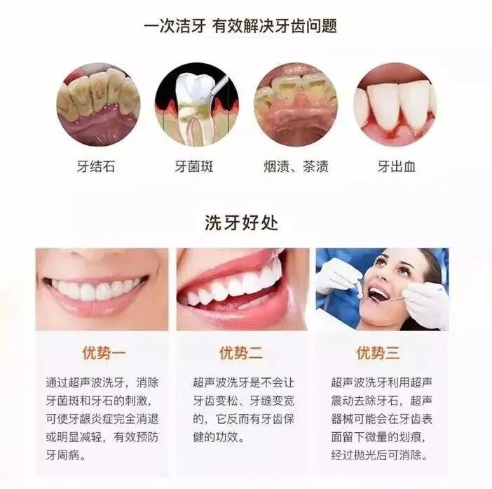 洗牙时口镜怎么放【银盆岭街道六沟垅2号口】28元抢门市价680元【卓尔口腔】成人／儿童二选一洁牙套餐，_https://www.jmylbn.com_新闻资讯_第15张