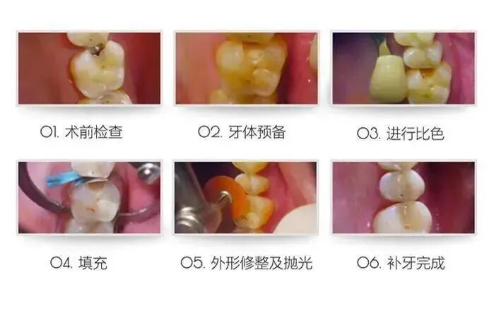 洗牙时口镜怎么放【银盆岭街道六沟垅2号口】28元抢门市价680元【卓尔口腔】成人／儿童二选一洁牙套餐，_https://www.jmylbn.com_新闻资讯_第18张