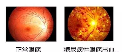 糖尿病人眼角膜更易損傷 最好別戴隱形眼鏡 健康 第1張