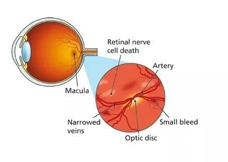糖尿病人眼角膜更易損傷 最好別戴隱形眼鏡 健康 第2張