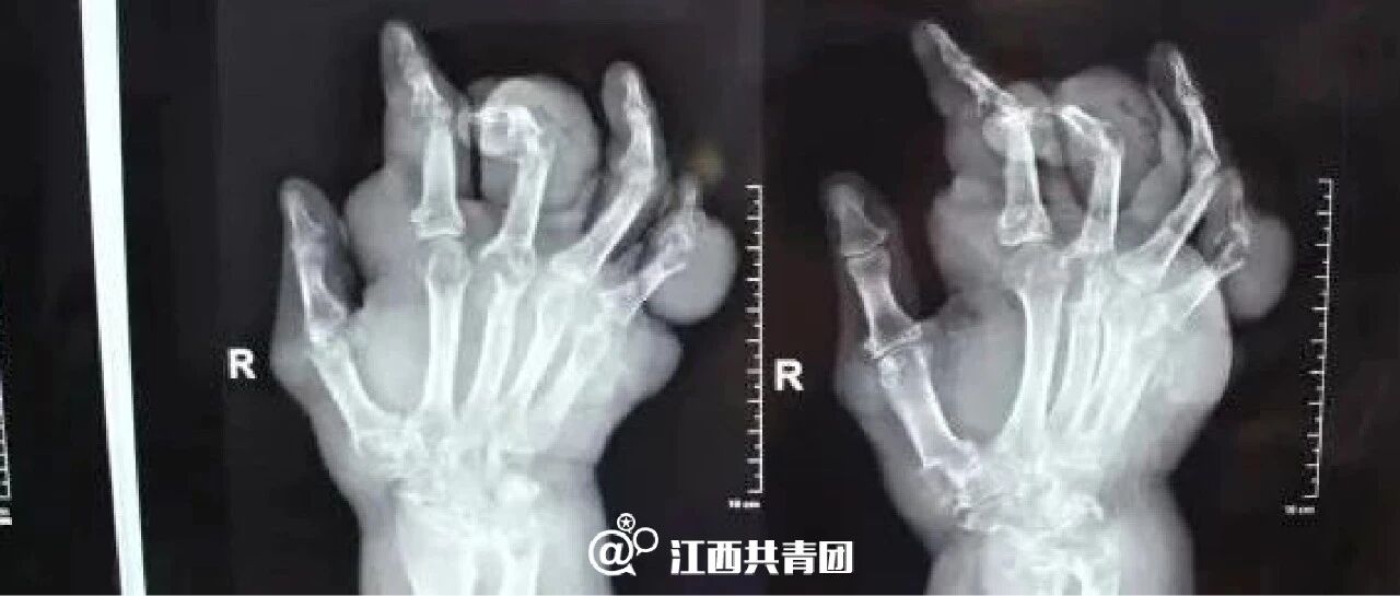 可怕！男子全身布满"石头"，只因喜欢…这些习惯很多人都有