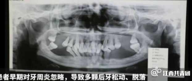 才29岁！女子牙齿掉了一大半，医生一看：剩下的也保不住了......