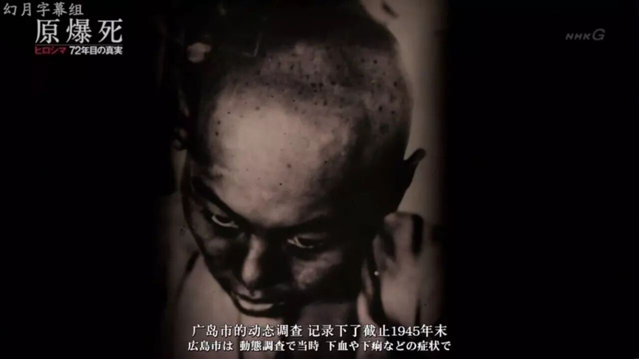 原子彈爆炸後 在被爆者身上發生了什麼 知日 微文庫