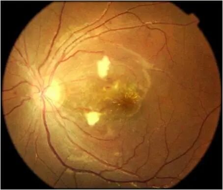 眼前节照相怎么照【全国爱眼日】眼底一张照，眼病早知道_https://www.jmylbn.com_新闻资讯_第8张