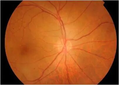 眼前节照相怎么照【全国爱眼日】眼底一张照，眼病早知道_https://www.jmylbn.com_新闻资讯_第3张