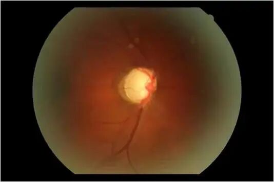 眼前节照相怎么照【全国爱眼日】眼底一张照，眼病早知道_https://www.jmylbn.com_新闻资讯_第7张