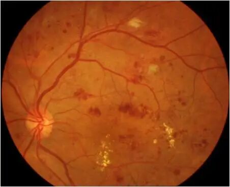 眼前节照相怎么照【全国爱眼日】眼底一张照，眼病早知道_https://www.jmylbn.com_新闻资讯_第5张