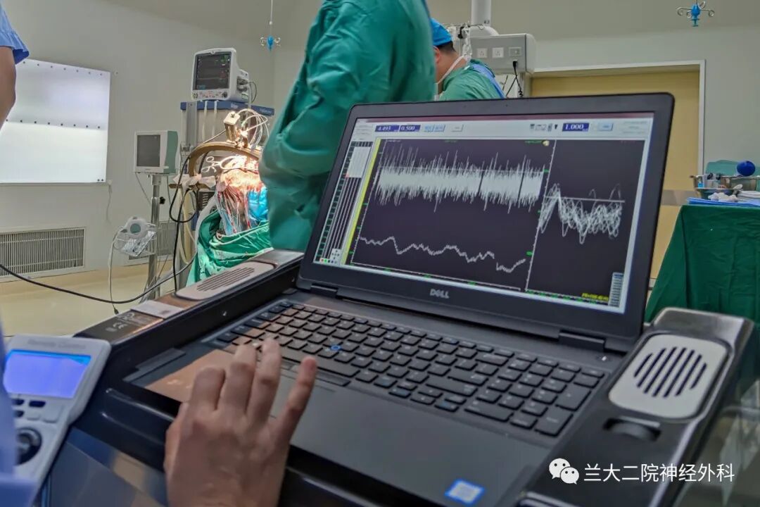 手电极怎么用【设备】兰大二院神经外科应用多通道微电极电生理记录技术辅助帕金森病DBS手术_https://www.jmylbn.com_新闻资讯_第3张