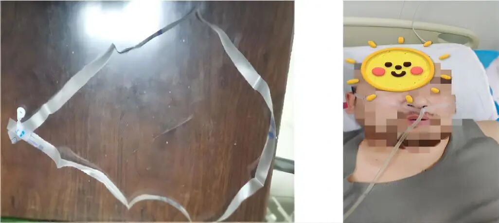 一次性胃管干什么用的护士把鼻饲真是“玩明白了”！这几个护理小发明真的很好用_https://www.jmylbn.com_新闻资讯_第8张