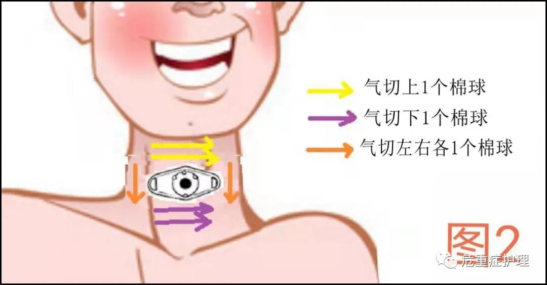气管套管怎么换药图文并茂：气管切开患者这样换药！_https://www.jmylbn.com_新闻资讯_第3张