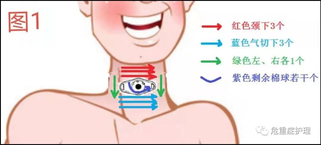 气管套管怎么换药图文并茂：气管切开患者这样换药！_https://www.jmylbn.com_新闻资讯_第2张