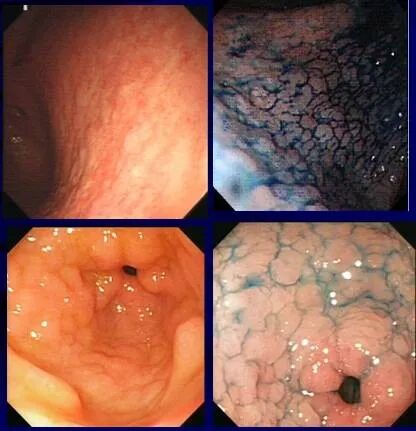 什么是氩气刀什么是萎缩性胃炎？是否癌变？如何治疗？_https://www.jmylbn.com_新闻资讯_第5张