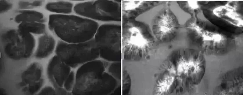 什么是氩气刀什么是萎缩性胃炎？是否癌变？如何治疗？_https://www.jmylbn.com_新闻资讯_第6张